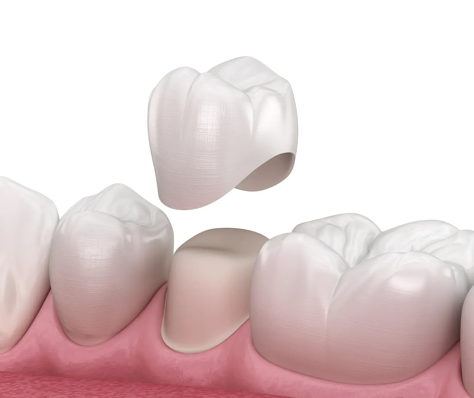 Photo related to dental crowns
