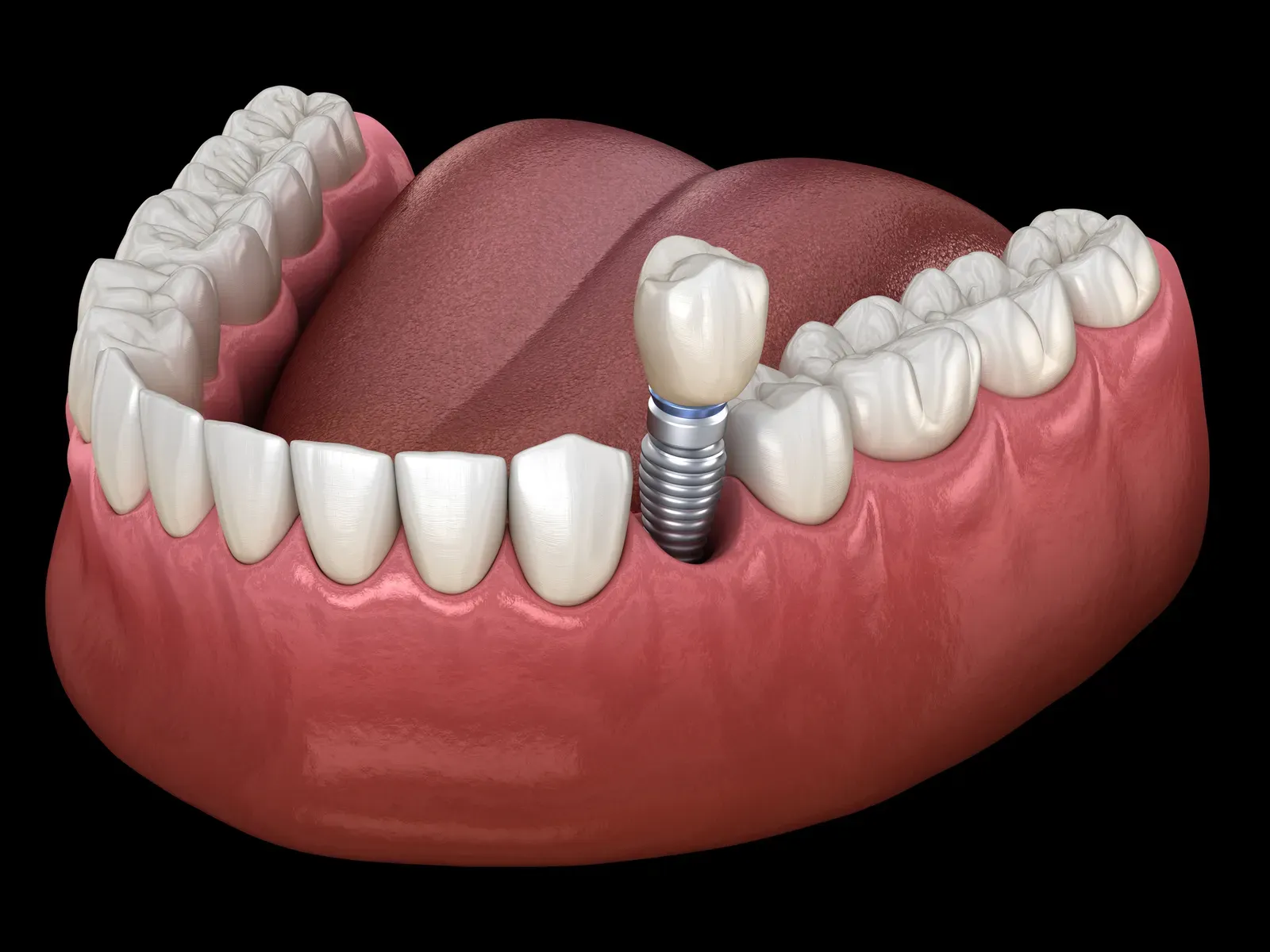 Photo related to dental implant