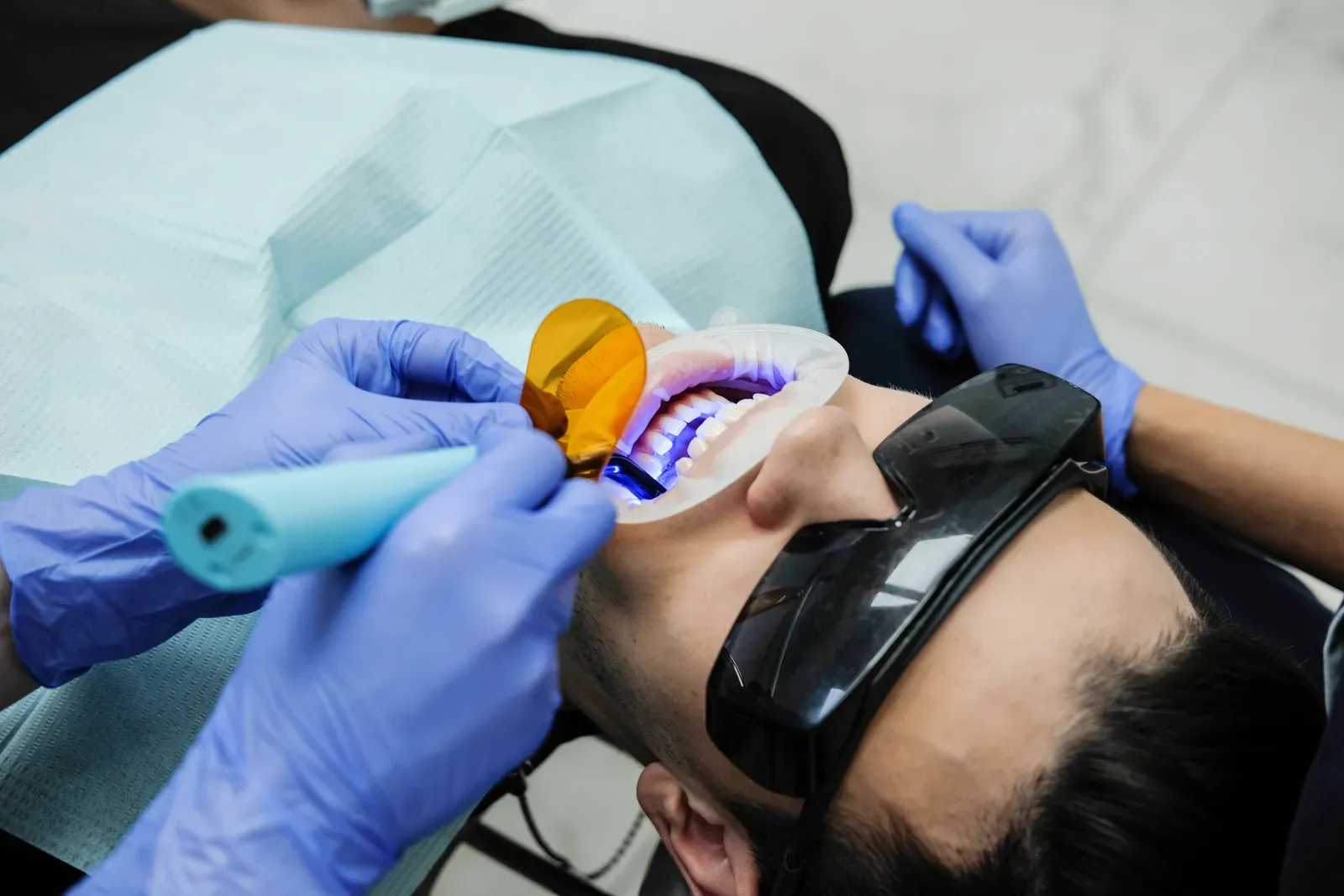 Dental Sealants